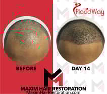 Slider image (2) MAXIM Hair Restoration Philippines